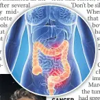  ??  ?? CANCER RISK
The large intestine