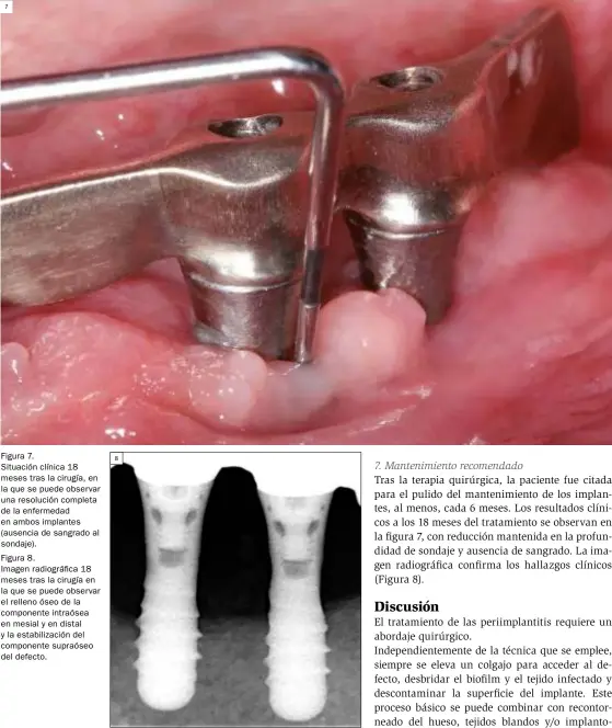  ??  ?? Figura 7. Situación clínica 18 meses tras la cirugía, en la que se puede observar una resolución completa de la enfermedad en ambos implantes (ausencia de sangrado al sondaje).
Figura 8.
Imagen radiográfi­ca 18 meses tras la cirugía en la que se puede observar el relleno óseo de la componente intraósea en mesial y en distal y la estabiliza­ción del componente supraóseo del defecto.