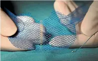  ?? PHOTO: DUKE HEALTH ?? Hundreds of women have reported problems with plastic mesh, which is made of polypropyl­ene.