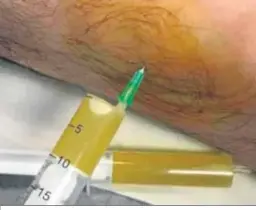  ??  ?? Imagen de una extracción de líquido sinovial de una rodilla.