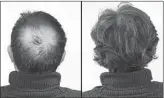  ??  ?? Breakthrou­gh research proves this discovery helps fill-in bald spots, re-nournishes thinning hair, and leads to noticeable growth in as little as 30 days.