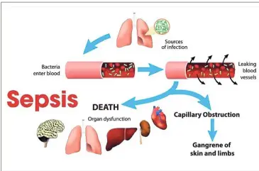  ??  ?? The origins of sepsis.