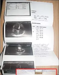  ?? (Pics: Themba Zwane) ?? Shadrack Lukhele, who is a retired Bulembu Mine worker and now suffers from asbestosis. (R) X-ray scans of his failing heart. (Inset) Lukhele’s employee ID while he worked at Bulembu Mine