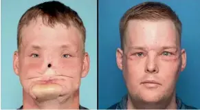  ??  ?? After a surgery that took 56 hours, Andy Sandness has another man’s face, thanks to a grieving widow’s generosity.