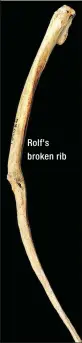  ??  ?? Rolf's broken rib