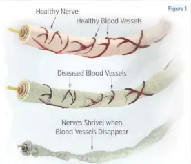  ??  ?? Figure 1: When these very small blood vessels become diseased, they begin to shrivel up and the nerves begin to degenerate.