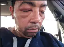  ?? COURTESY OF JUAN MORALES ?? Juan Morales alleged “crooked” Trenton cop Travis Maxwell caused the injuries seen here all because Morales shouted “f**k you” to the cop while filming his brother’s arrest.