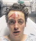  ?? FACEBOOK PHOTOS ?? Chance Johnson suffered multiple face and head injuries, as depicted in these Facebook photos, after he says he was deliberate­ly struck by a vehicle.