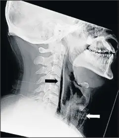  ??  ?? X-rays showing the tear in the upper throat of a man who had stifled a sneeze by pinching his nostrils and keeping his mouth closed. The force of the restricted air caused the rupture of the pharynx.