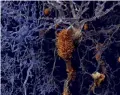  ??  ?? Alzheimer's victims produce plaque in their brains (orange), but scientists might have a cure.