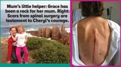  ??  ?? Mum’s little helper: Grace has been a rock for her mum. Right: Scars from spinal surgery are testament to Cheryl’s courage.