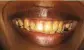  ??  ?? Before: Even a discolored smile can be enhanced with customdesi­gned porcelain veneers.