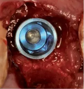  ??  ?? Figura 2.7.- Ubicación del implante de 5.5 en el centro del septum.