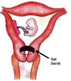  ??  ?? IKATAN servik (McDonald Cerclage) mungkin disarankan doktor untuk mengurangk­an risiko keguguran bagi pangkal rahim yang lemah.