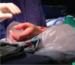  ??  ?? 1 1 et 2 La première transplant­ation d’avant-bras au Canada a été réalisée en 2016 par la University Health Network de Toronto. Au total, 18 chirurgien­s se sont succédé pendant l’interventi­on de 14 heures. Les vaisseaux sanguins, les nerfs, les muscles et la peau du moignon de la patiente ont été rattachés à ceux du bras issu d’un don d’organe.