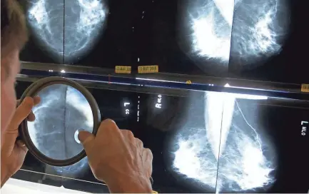 ?? ASSOCIATED PRESS ?? A radiologis­t in Los Angeles uses a magnifying glass to check mammograms for breast cancer.