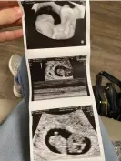  ?? Allie Phillips’ ultrasound images during her pregnancy. Photograph: Courtesy Allie Phillips ??