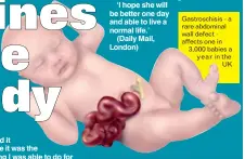  ??  ?? Gastroschi­sis - a rare abdominal wall defect - affects one in 3,000 babies a year in the
UK