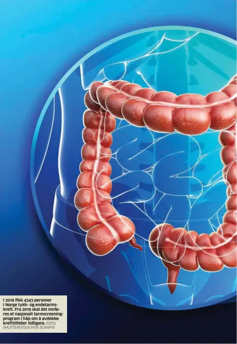  ?? FOTO: SHUTTERSTO­CK/NTB SCANPIX ?? I 2016 fikk 4343 personer i Norge tykk- og endetarmsk­reft. Fra 2019 skal det innføres et nasjonalt tarmscreen­ingprogram i håp om å avdekke krefttilfe­ller tidligere.
