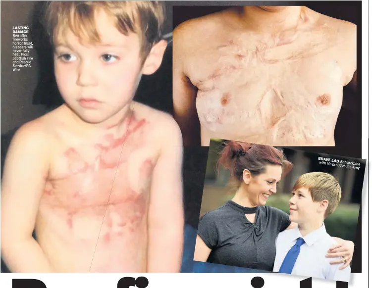  ??  ?? LASTING DAMAGE Ben after fireworks horror. Inset, his scars will never fully heal. Pics: Scottish Fire and Rescue Service/PA Wire BRAVE LAD with his Ben proud mu