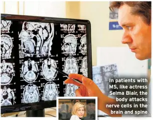  ?? ?? In patients with MS, like actress Selma Blair, the body attacks nerve cells in the brain and spine