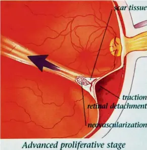  ??  ?? In proliferat­ive diabetic retinopath­y, fragile new blood vessels grow along the inside surface of the retina and into the vitreous gel, which are likely to leak and bleed. Accompanyi­ng scar tissue can contract and cause retinal detachment, which can lead to permanent vision loss.