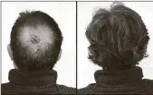  ??  ?? Breakthrou­gh research proves this discovery helps fill-in bald spots, re-nournishes thinning hair, and leads to noticeable growth in as little as 30 days.