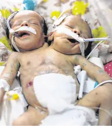  ??  ?? Newly born conjoined twins Abdelkhale­q and Abdelkarim lie in an incubator in intensive care at al-Thawra hospital in Sanaa