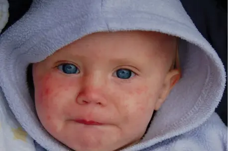  ?? (Illustrati­ve; Dave Haygarth/Flickr) ?? A CHILD with measles.