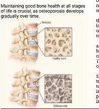 Preventing bone deteriorat­ion - PressReader