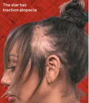  ??  ?? The star has traction alopecia