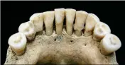 ?? ASSOCIATED PRESS ?? THIS UNDATED PHOTO released by the Max Planck Institute for the Science of Human History in Jena, Germany, shows the dental calculus on the lower jaw where a medieval woman entrapped lapis lazuli pigment, seen below center tooth.