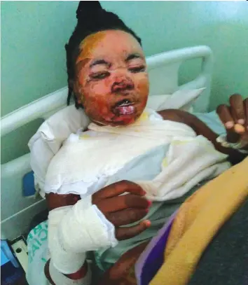  ??  ?? The badly burnt Michelle Masango recuperate­s at Mutare Provincial Hospital