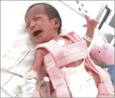  ?? COURTESY PHOTO ?? Anna Cecilia Alvanes, who was about a month old at the time, wears a pink brace while hospitaliz­ed in 2019.