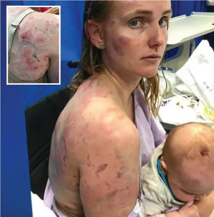  ?? Photo: Contribute­d ?? CLOSE CALL: Fiona Simpson in Kingaroy Hospital after she was hit by hail and INSET: A close-up of her injuries.