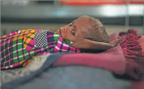  ?? MONEY SHARMA / AFP ?? A four-year-old malnourish­ed child being treated at the Nutritiona­l Rehabilita­tion Centre in the eastern Indian state of Bihar in October 2015.