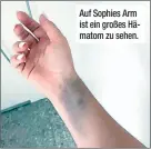  ??  ?? Auf Sophies Arm ist ein großes Hämatom zu sehen.