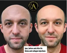  ?? ?? Igor, before and after his Botox and collagen injections