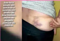  ?? ?? Este foi o estado em que ficou a zona do rim direito de Ana Dionísio, depois do alegado pontapé do médico.