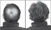  ??  ?? Breakthrou­gh research proves this discovery helps fill-in bald spots, re-nournishes thinning hair, and leads to noticeable growth in as little as 30 days.