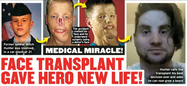  ?? ?? Former soldier Mitch Hunter was involved in a car crash at 21
The accident melted his face and he underwent surgery using a donor’s face
Hunter calls the transplant his best decision ever and adds he can now grow a beard