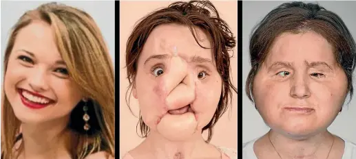  ?? CLEVELAND CLINIC, STUBBLEFIE­LD FAMILY ?? Katie Stubblefie­ld is pictured, from left, before her suicide attempt, after initial surgery and after face replacemen­t operations.