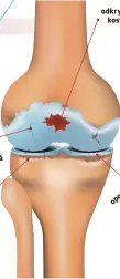  ?? ?? chrupavka
meniskus odkrytá
kost opotřebova­ný
meniskus