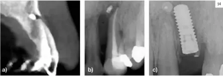  ??  ?? Figura 14. a) Situación 3D previa a la extracción. b) Radiografí­a periapical previa a la extracción. c) Radiografí­a periapical inmediata postoperat­oria a la colocación de implante y membrana no reabsorbib­le. 14