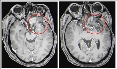  ??  ?? This combinatio­n of MRI images provided by the University of Alabama in April 2021 shows scans of a child with a brain tumor, before and after a treatment that involves using viruses to spur an immune system response to the cancerous cells. Lighter-colored areas inside the red circles indicate the tumor size. (AP)