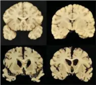  ?? DR. ANN MCKEE — BU VIA AP ?? This combinatio­n of photos provided by Boston University shows sections from a normal brain, top, and from the brain of former University of Texas football player Greg Ploetz, bottom, in stage IV of chronic traumatic encephalop­athy.