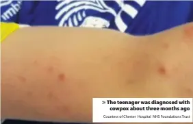  ?? Countess of Chester Hospital NHS Foundation­s Trust ?? > The teenager was diagnosed with cowpox about three months ago
