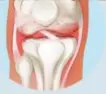  ??  ?? Knee joint with arthritis