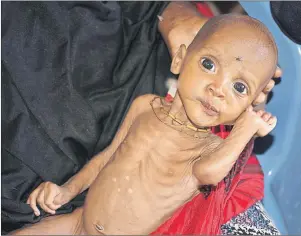  ?? AP PHOTO ?? Ali Hassan, 9 months old, is held by his mother Fadumo Abdi Ibrahim, who fled the drought in southern Somalia, at a feeding center in a camp in Mogadishu, Somalia, on Sunday.