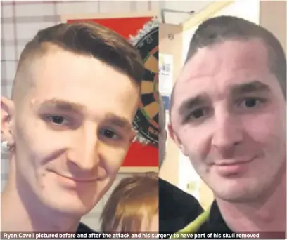  ??  ?? Ryan Covell pictured before and after the attack and his surgery to have part of his skull removed